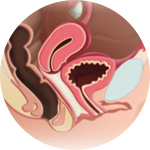 rejuvenecimiento-vaginal
