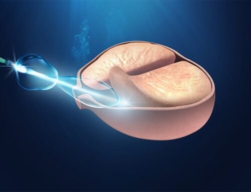 Cirugía láser de próstata con Holmium: una solución moderna, segura y eficaz